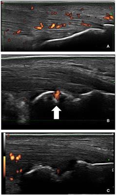 Entheseal Involvement in Spondyloarthritis (SpA) and Gout: An Ultrasound Comparative Study